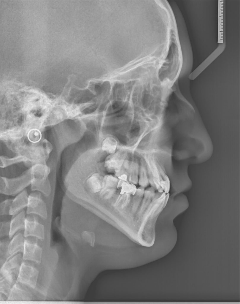 رادیوگرافی برای درمان ارتودنسی