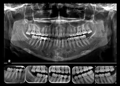 رادیوگرافی برای تشخیص پوسیدگی‌های دندانی