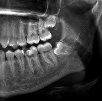 رادیوگرافی دندان عقل