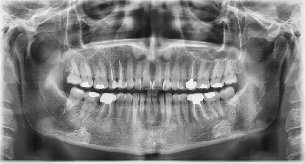 عکس OPG برای چیست
