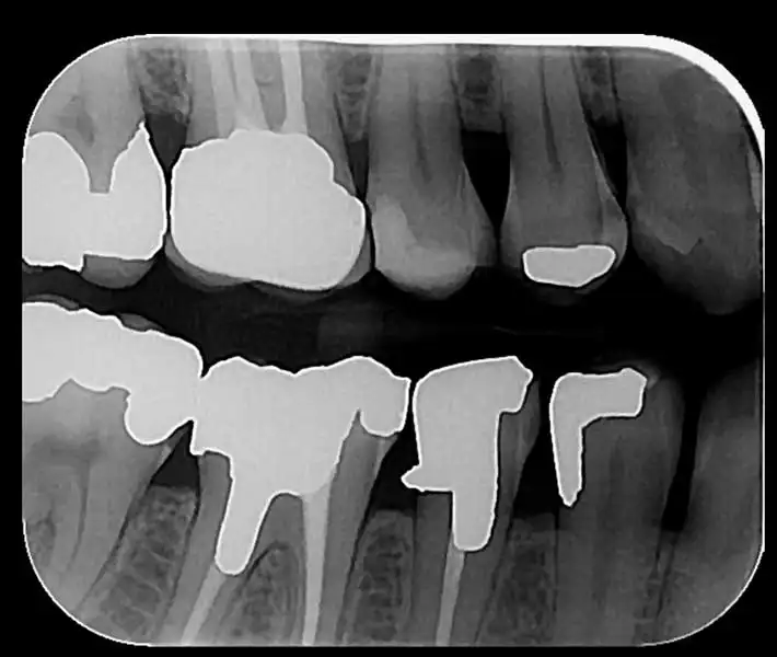 رادیوگرافی بایت وینگ