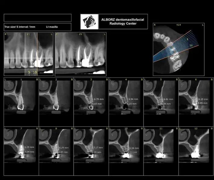 سی تی اسکن (CBCT)
