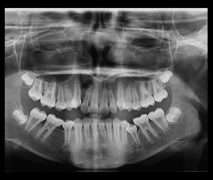 پانورامیک (OPG)