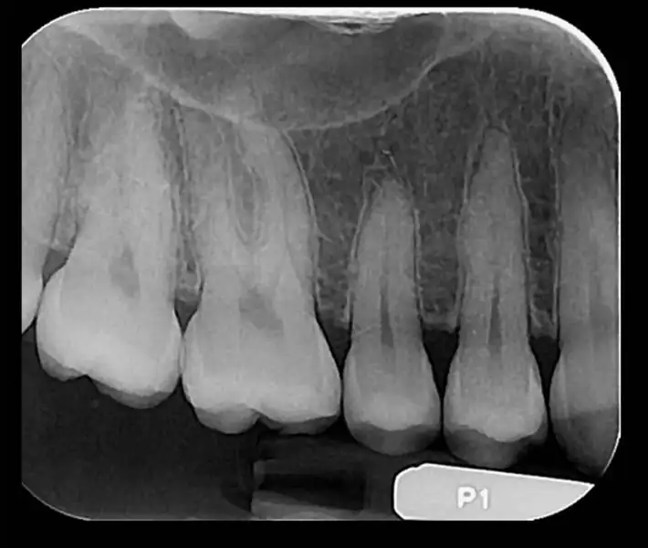 رادیو گرافی پری اپیکال