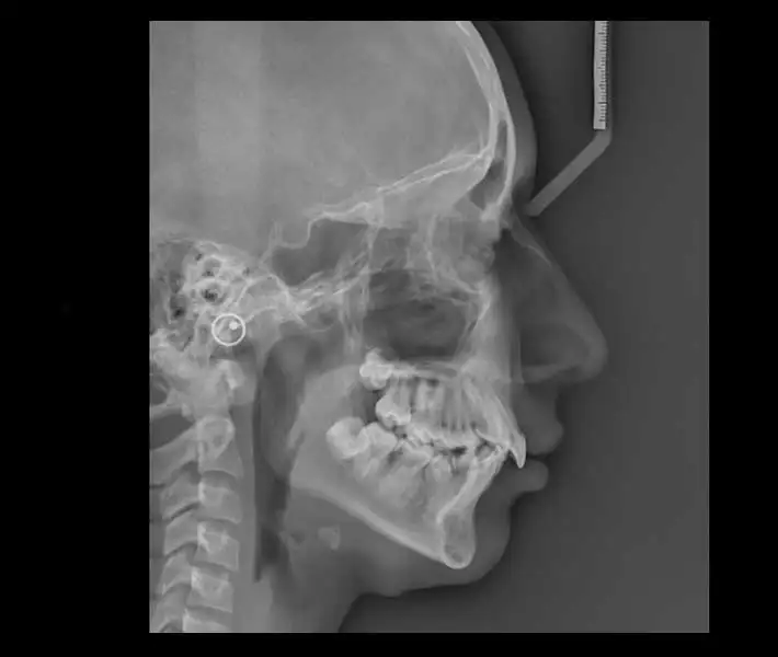 لترال سفالومتری